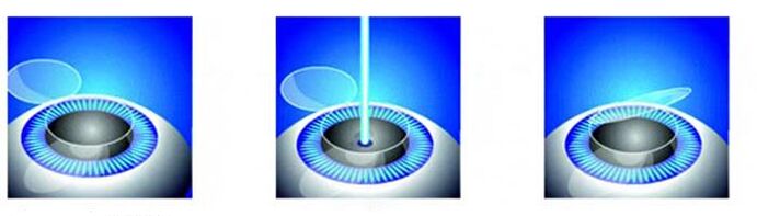 Steps of laser vision correction